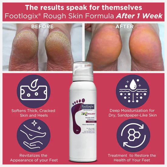 Footlogix Rough Skin Formula (125ml)
